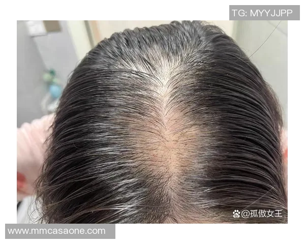 足球明星脱发排行榜揭晓谁是最受脱发困扰的球员